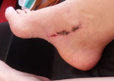 Wound Healing after operation