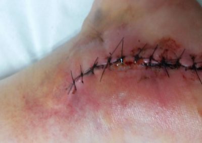 Broken foot operation