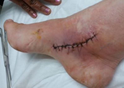 wound healing 2