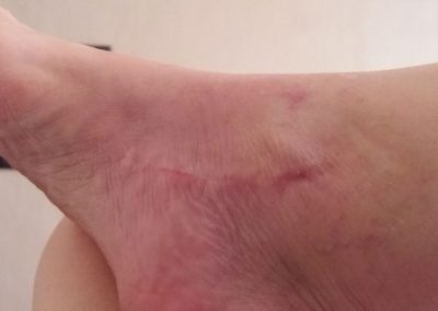 Wound Healing post operational