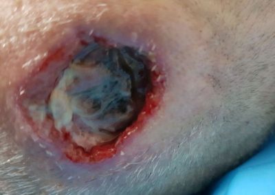 Wound Healing bedsores