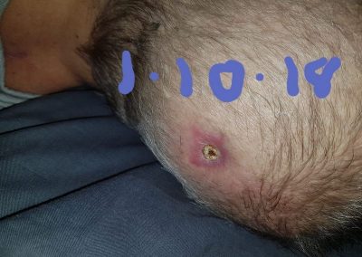 Wound Healing with Rife therapy